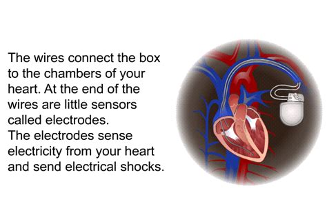 PatEdu.com : Implantable Cardioverter Defibrillator