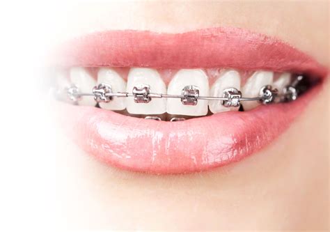 Types Of Braces Specialist Orthodontist In Dublin Dundrum Orthodontics