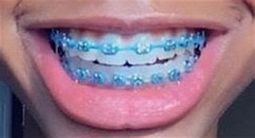 baby blue braces colors - Deanne Hamrick