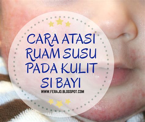 Cara Atasi Ruam Susu Pada Kulit Si Bayi