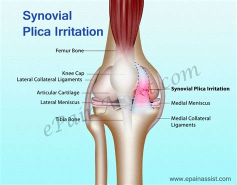 Synovial Plica Etiology Plica Snap Leg Presses Knee Exercise Leg