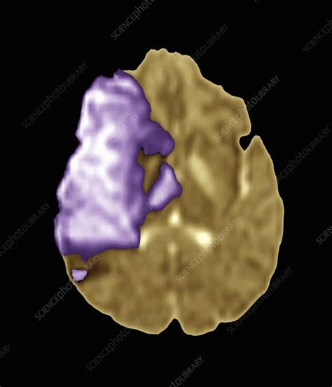 Stroke, MRI scan - Stock Image - C015/2736 - Science Photo Library