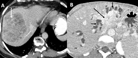 Figure 1 From Editorial Role Of Imaging In Biliary Tract Cancer