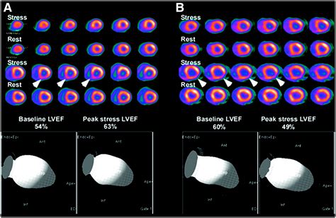 Clinical Myocardial Perfusion Pet Ct Journal Of Nuclear Medicine