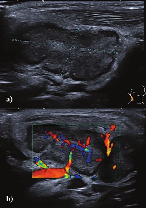 A reactive lymph node. a) Conventional ultrasound of a reactive lymph ...