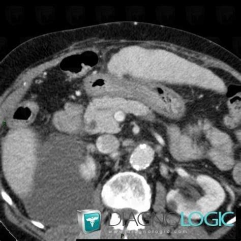 Radiology case : Pancreas divisum (CT) - Diagnologic