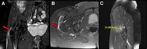 Representative Magnetic Resonance Images Of Both A Right Sided Gluteus