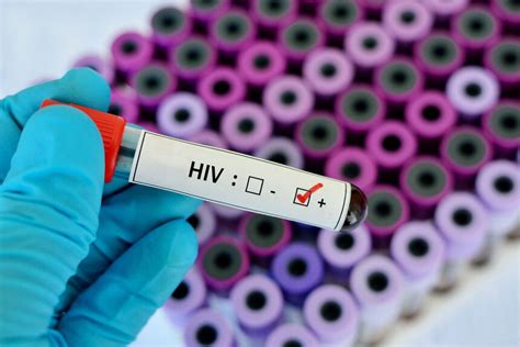 HIV ludzki wirus niedoboru odporności przyczyny objawy leczenie