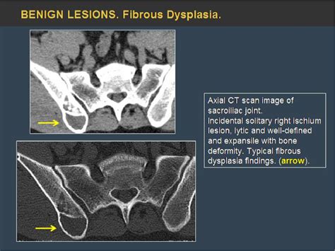 Figure 19 From Pelvic Bone Lesions A Radiologic Pictorial Review