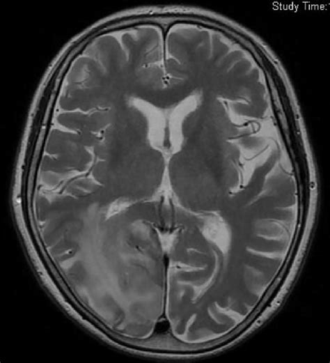 Figure2.Magnetic resonance imaging (MRI) of the CNS lesion. MRI... | Download Scientific Diagram