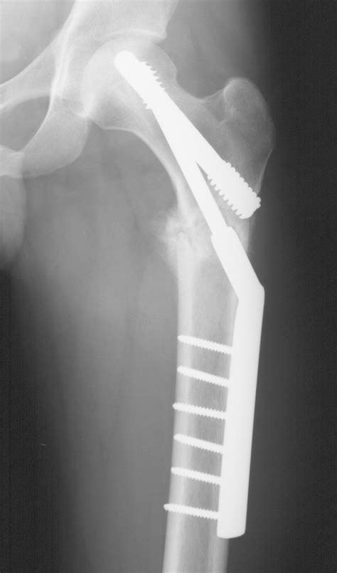 Subtrochanteric Femur Fracture After Core Decompression And Placement