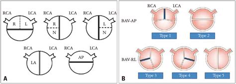 Bicuspid Aortic Valve Unresolved Issues And Role Of Imaging Specialists