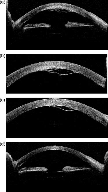 Anterior Segment Optical Coherence Tomography Of The Descemet’s Download Scientific Diagram