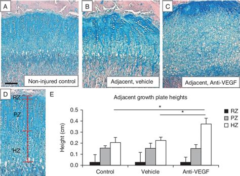 Hypertrophic Zone Expansion At The Regions Of Growth Plate Adjacent To