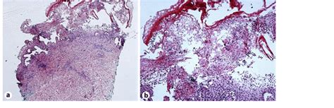 Punch Biopsy Showing Interface Vesicular Dermatitis With Epidermal