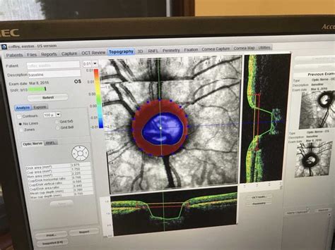 Optos OCT SLO Retina Glaucoma Cornea Analysis - Nava Ophthalmic