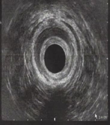 D Endoanal Ultrasound Showing Thinning Of The Anal Canal Without Any