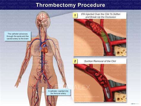 Thrombectomy Procedure Trialquest Inc