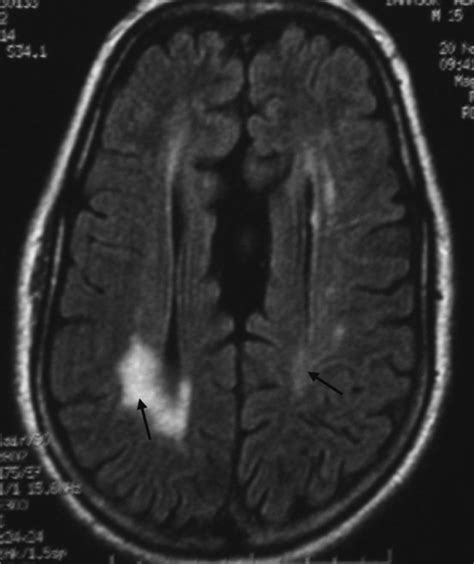 Flair Weighted Axial Mri Sequence Showing Bilateral Periventricular Download Scientific Diagram