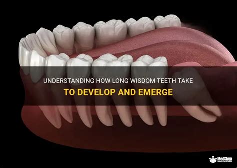 Understanding How Long Wisdom Teeth Take To Develop And Emerge | MedShun