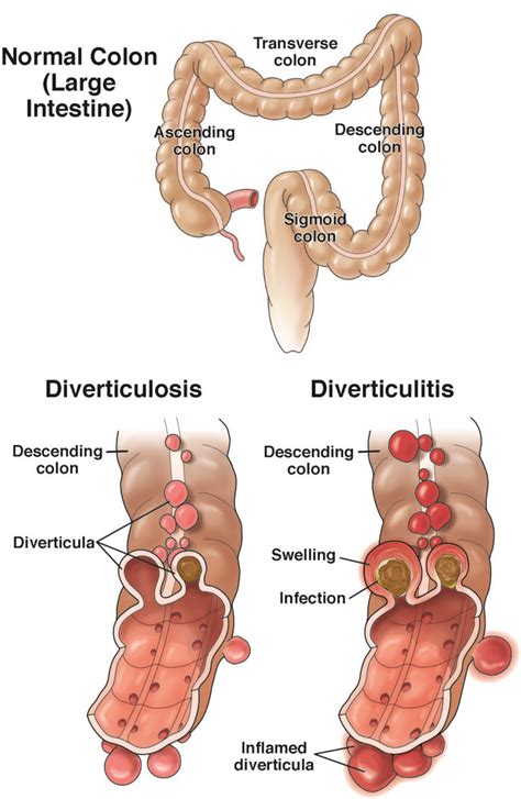 Diverticulosis What It Is Symptoms Causes Treatment 50 Off