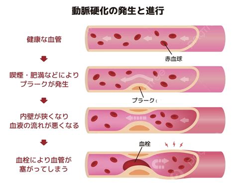 Progression Of Arteriosclerosis Illustration Surgery Blood Plaque