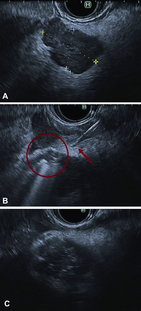 Eus Guided Radiofrequency Ablation Rfa Of Insulinoma A A Hypoechoic