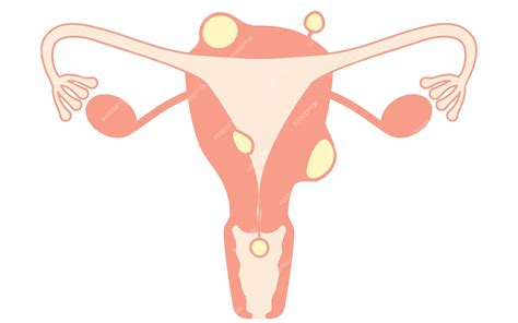 Premium Vector Diagrammatic Illustration Of Uterine Fibroids Anatomy