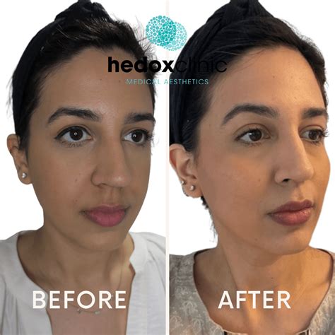 Nasolabial Folds Treatment London Nasal Fold Filler Hedox Clinic