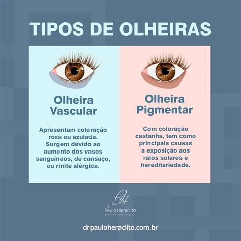 O'que Causa Olheira - 👀Você sabia que existem esses dois tipos de olheiras, com ...