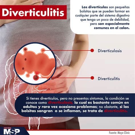 Diverticulitis