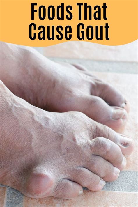 Foods That Cause Gout Foods That Cause Gout Gout How To Cure Gout