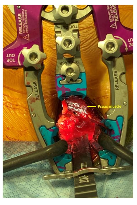 Three-dimensional Navigation-guided, Prone, Single-position, Lateral