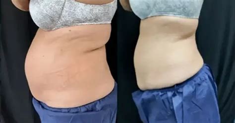 The Ultimate Guide To CoolSculpting In Naples Kenzi MedSpa