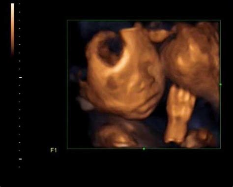 Successful 4D Ultrasound Imaging of Fetal Face with clear facial ...