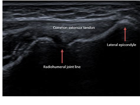 Figure 2 From Assessment Of Common Extensor Tendon Vascularization