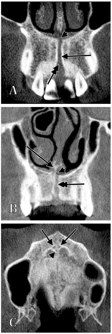 Nasopalatine Canal Radiograph