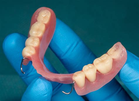 Precision Partial Dentures