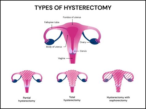 Hysterectomy And Tubal Ligation May Increase Heart Disease Risk