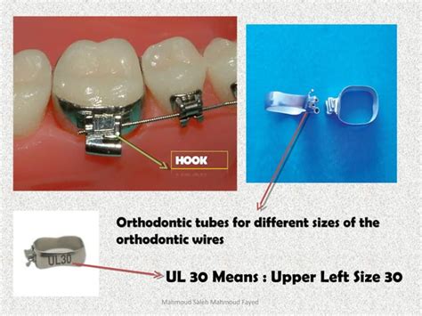 Orthodontic Appliances Ppt