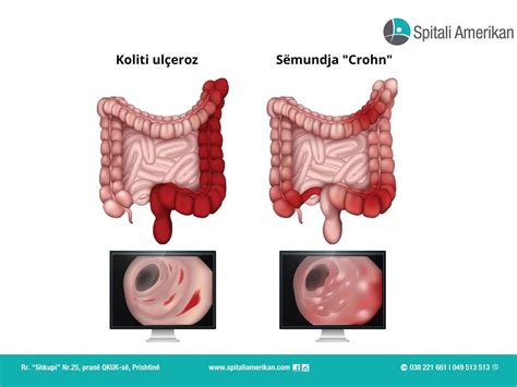 Dallimi midis sëmundjes Crohn dhe kolitit ulçeroz Gazeta Express