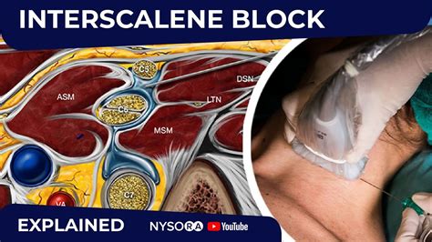 Us Guided Interscalene Brachial Plexus Block Regional Anesthesia