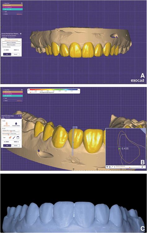 Preparation Of Ultrathin Translucent Zirconia Laminate Veneers Using 3D