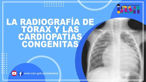 La Radiografía de Tórax y las Cardiopatías Congénitas