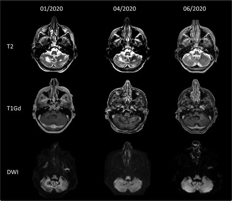 Magnetic Resonance Imaging Findings Over Time Upper Row T2 Weighted