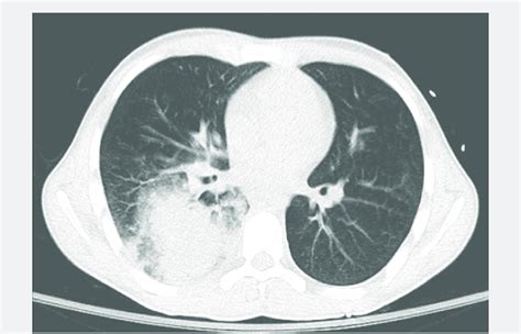 B Computed Tomography Scan Of The Chest Axial Plane Reveals A Rll