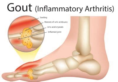 Gout - Family Foot and Ankle Care of Greenville