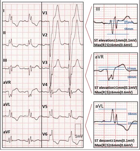 Ecg From A Patient With Acute Myocardial Infarction And Culprit Artery Download Scientific