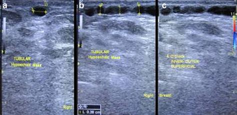 Mondor’s Disease Classical Imaging Findings In The Breast Bmj Case Reports