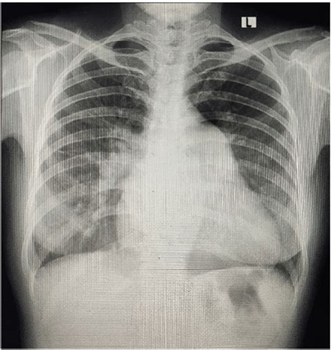 Posterior Anterior Chest X Rays Demonstrated Markedly Enlarged Cardiac